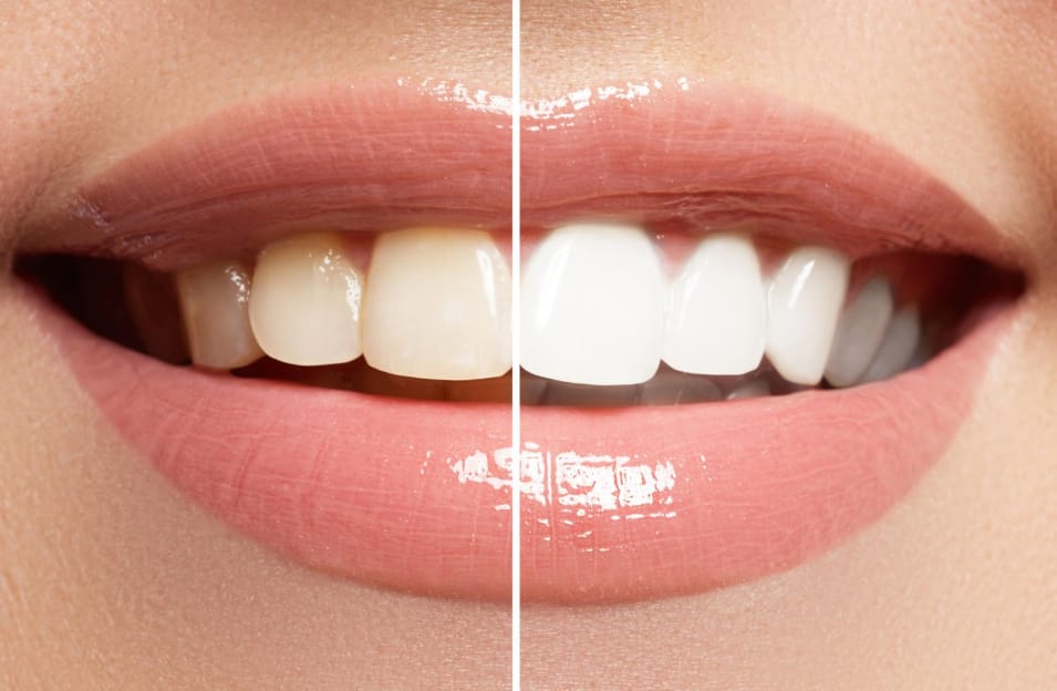 Professional Options for Effective Teeth Whitening in Ottawa