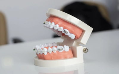 Beyond Braces: Discover the Benefits of Modern Orthodontic Treatment